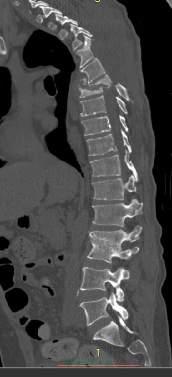 Fig. 5: This image presents acute spondylodiscitis at the level Th6-Th7 with development of kyphotic deformation of the spine and also this image presents