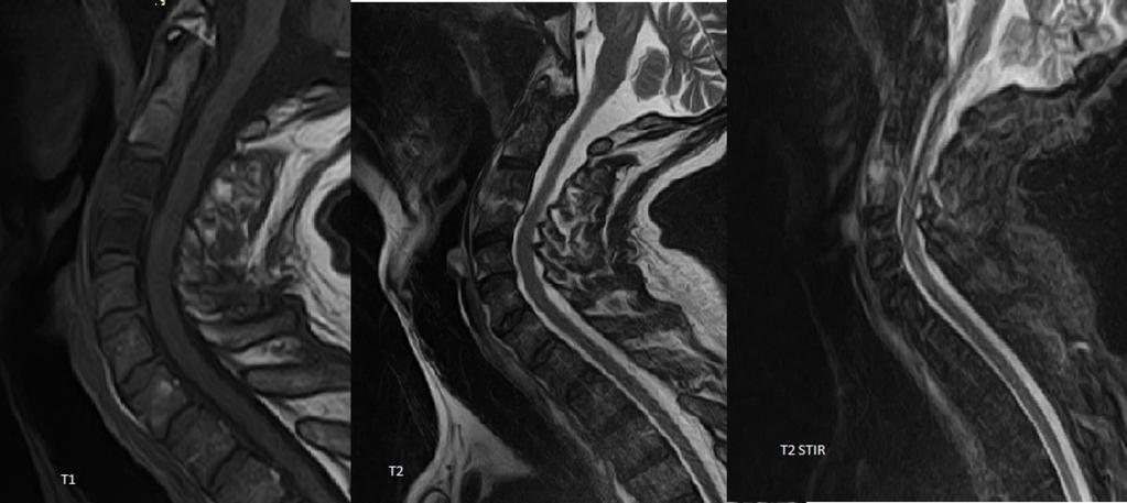 Fig. 6: Spondylodiscitis at the level C3-C4 on MRI-imaging.