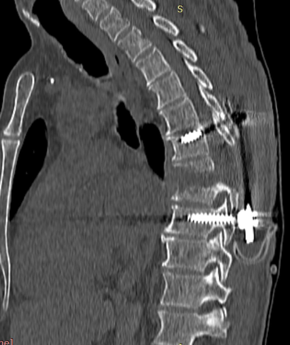 Fig. 2: Spondylodiscitis at the level Th6-Th7 as complications after surgeries
