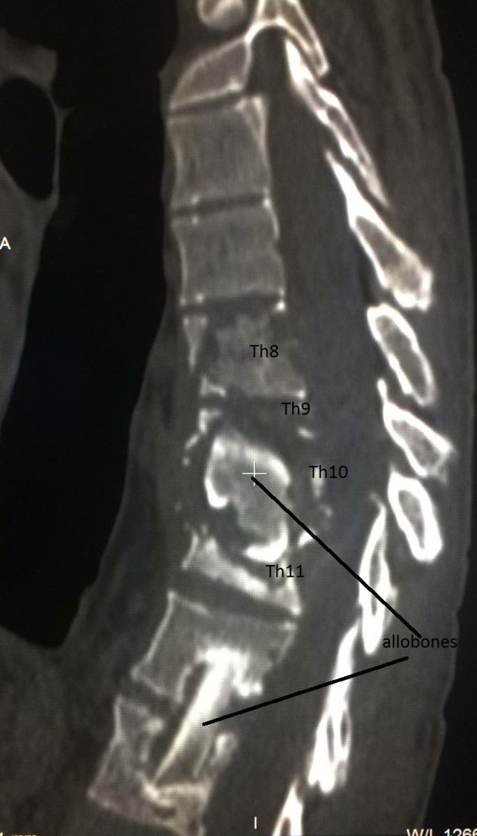 Fig. 3: Relapse of tuberculocis spondylodiscitis in HIV-positive person at the