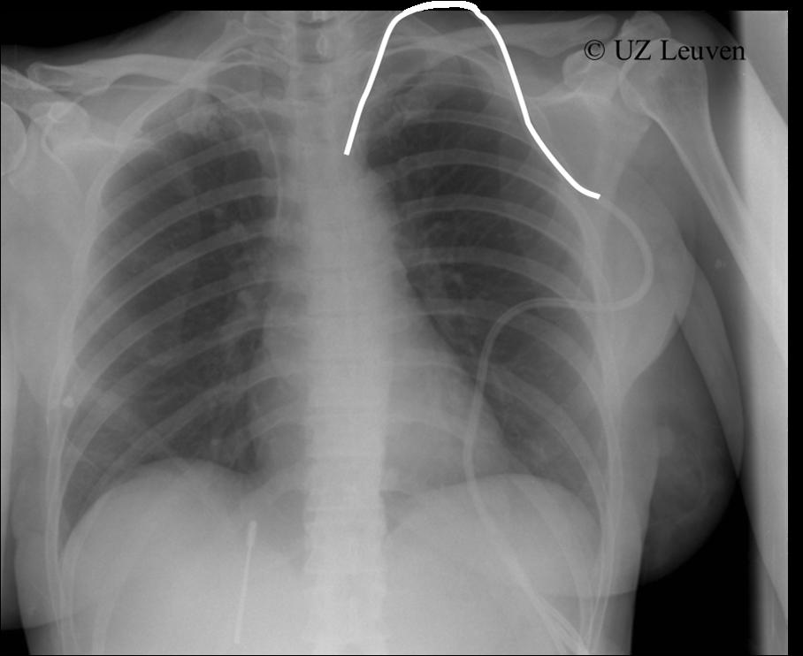 Chest X-ray front/side view