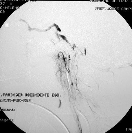 INTRA-ARTERIAL EMBOLIZATION Left cavernous sinus DAVM type I SILAN 25th 2008 SIMI - CANCÚN Buenos Aires -