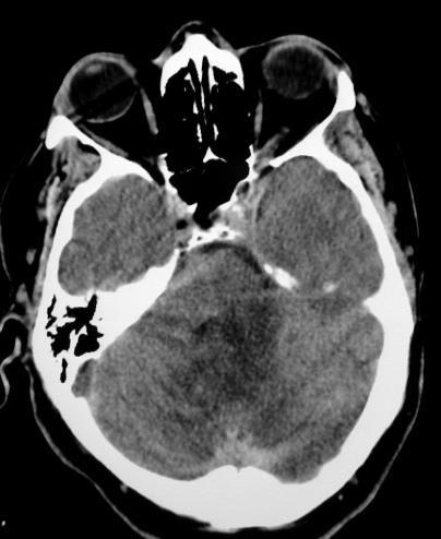 INTRA-ARTERIAL EMBOLIZATION GLUE - NBCA distal meningeal arteries high