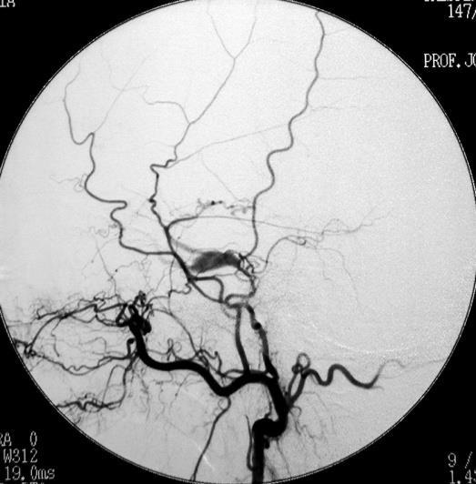 INTRA-ARTERIAL EMBOLIZATION Multiple shunts high and