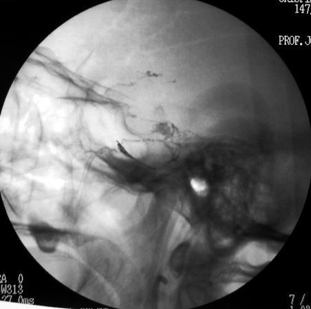 maxilary artery with PVA