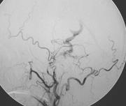 middle meningeal artery