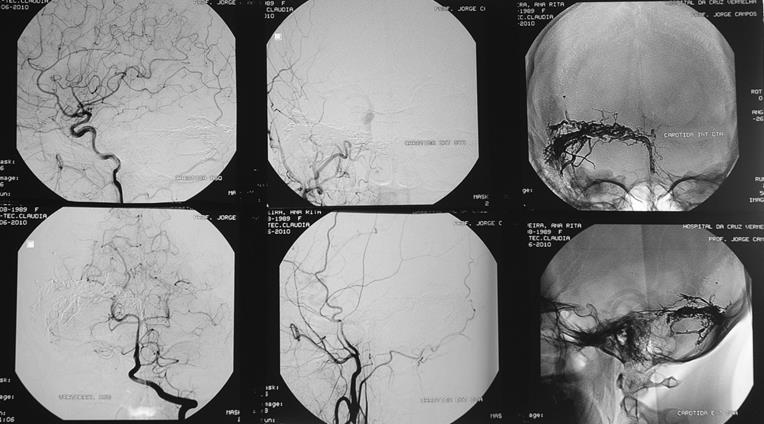 INTRA-ARTERIAL EMBOLIZATION Right lateral sinus DAVM type II