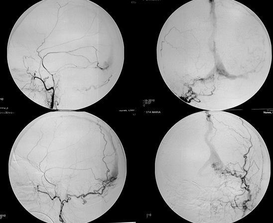 INTRA-ARTERIAL EMBOLIZATION DAVM type II torcular region 72 y with dementia right and left middle meningeal