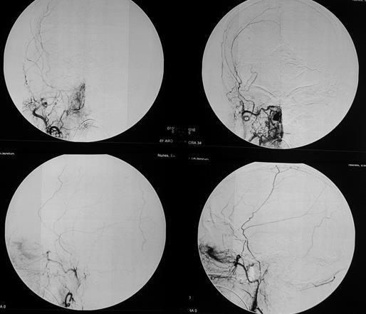 INTRA-ARTERIAL EMBOLIZATION DAVM type II torcular region Follow-up right and