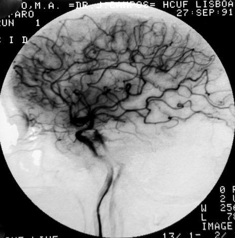 intra-arterial embolization with