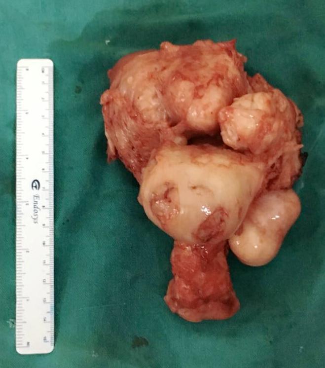 Figure 4: Exvivo hysterectomy piecemeal specimen Table 1: Indications of NDVH Table z: Distribution according to uterine size Table 3: Comparison of results between different studies *Gayathri KB.