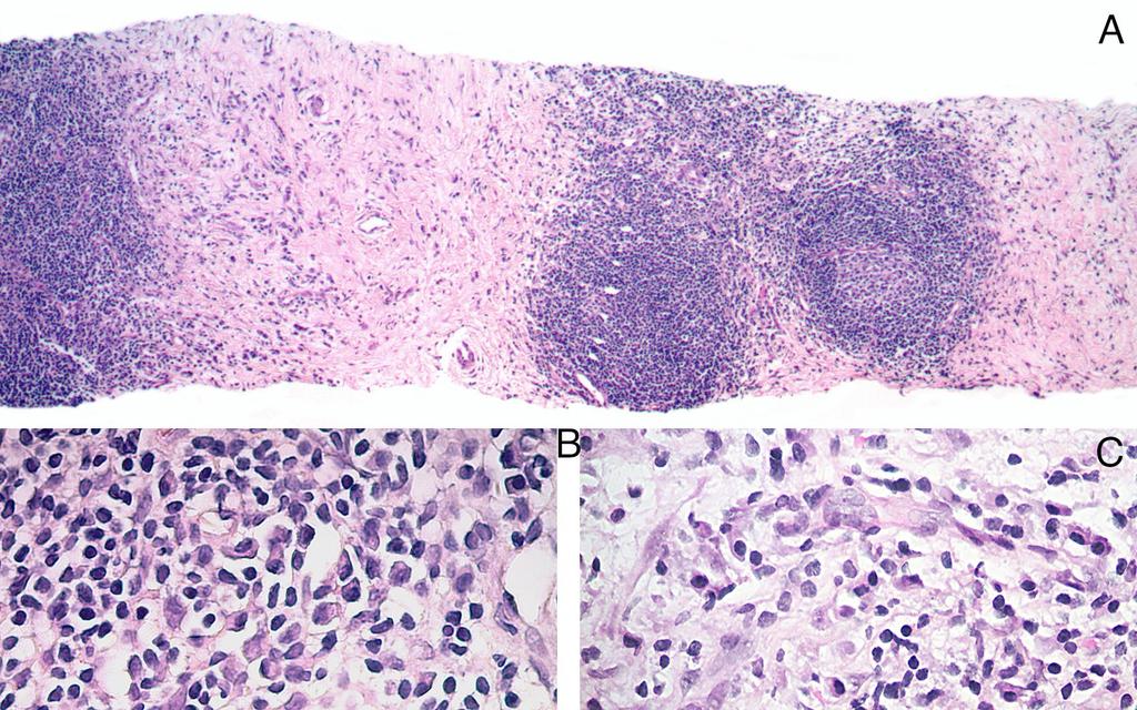 Figure 2: 23 year old female presented with a painless palpable right neck mass, which was subsequently diagnosed as IgG4- related disease.