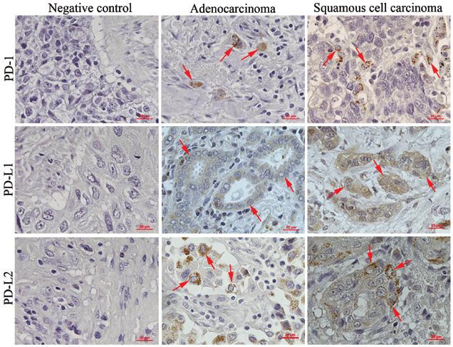 ONCOLOGY LETTERS 12: 921-927, 2016 925 Figure 1. Representtive photomicrogrphs of immunohistochemicl stining. Arrows indicte the positively stined cells. Originl mgnifiction, x400.