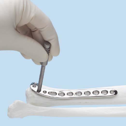 Insert Plate K-wires can be placed through the distal end of the plate to assist with temporary maintenance of the reduction and for plate placement.