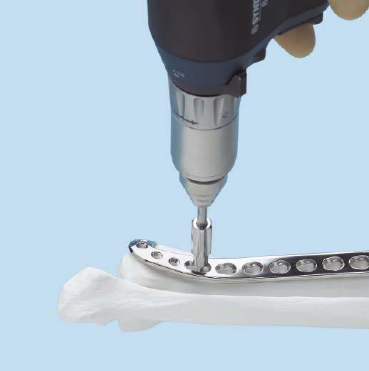 This instrument can be used for: Stabilization of plate-bone orientation during insertion of the first screws Translational adjustments Provisional fixation Alignment of segmental fragments Minor
