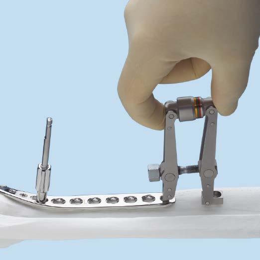 Articulated tension device (optional) Instrument 321.