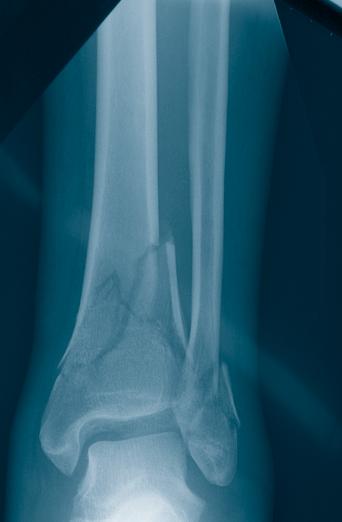 fractures, osteotomies and nonunions of the distal tibia,