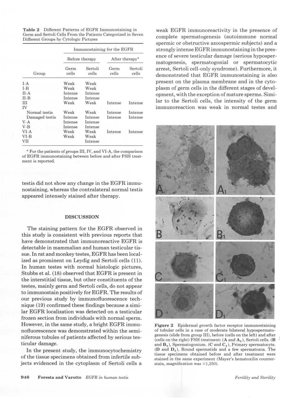 Table 2 Different Patterns of EGFR Immunostaining in Germ and Sertoli Cells From the Patients Categorized in Seven Different Groups by Cytologic Pictures Immunostainil).