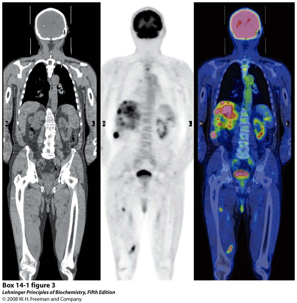 Detection of cancerous tissue is possible with positron emission tomography (PET).