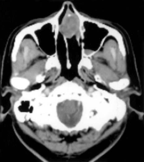 DISCUSSION Adenoid cystic carcinoma in the nasal cavity and paranasal sinuses origin often has a worse prognosis than in any other area of the head and neck region.