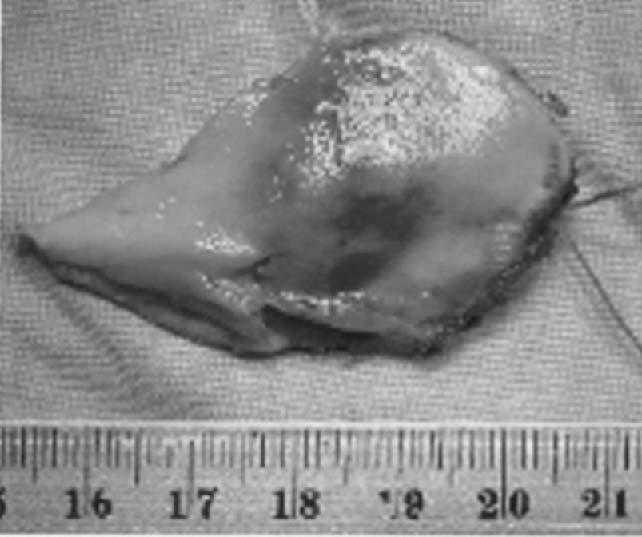 S.Y. Tai, C.Y. Chien, C.F. Tai, et al A B C D Figure 2. The nasal septum tumor is covered by intact nasal mucosa bilaterally. The tumor size is 4.0 3.0 0.