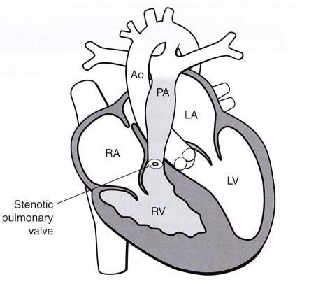 Valvular PS (m/c) Pulmonary Stenosis (PS) Obstruction of RVOT fusion of valve commissures or dysplastic PV post-stenotic MPA dilatation variable - profound dilatation in mild cases RV