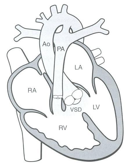 Tetralogy of Fallot (TOF), classic form Subaortic malaligned VSD: perimembranous (m/c) Overriding dilated aortic root (>50% overlies LV) Infravalvular (infundibular) PS - hypoplasia of pulmonary