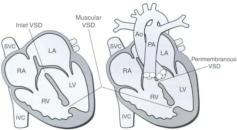 Ventricular Septal Defects (VSD) Inlet VSD: In apical 4CV, posterior to TV Muscular VSD: In apical or