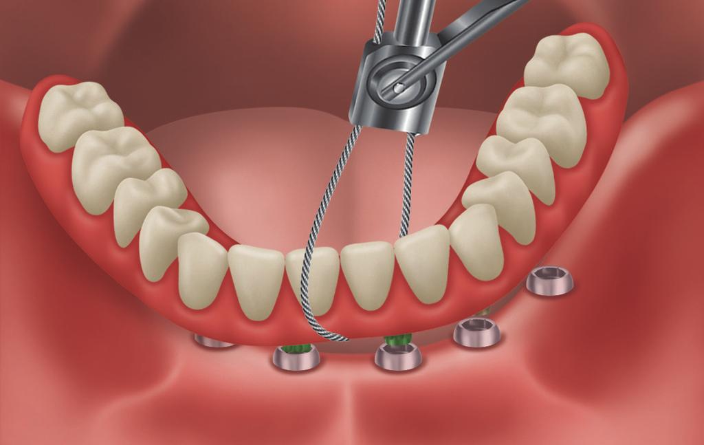 10B NOTE: Hold the prosthesis when disengaging the final Abutments, as the prosthesis can spring off the Abutments.