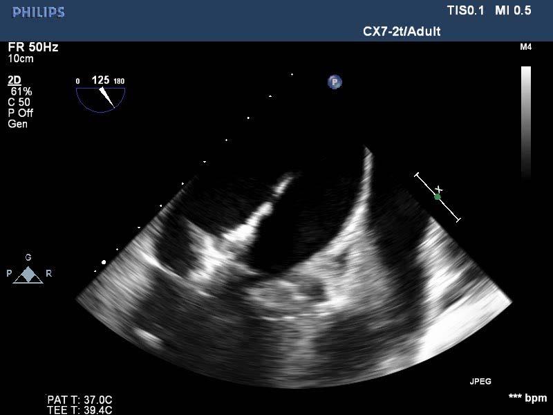 The Mitral Valve