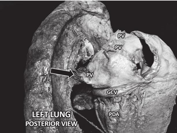 LA = left atrium, LT PV = left pulmonary vein, RT PV = right pulmonary vein, RV = right ventricle. Figure 2: Case 2 Posterior view of the left lung and heart of an 85-year-old female.