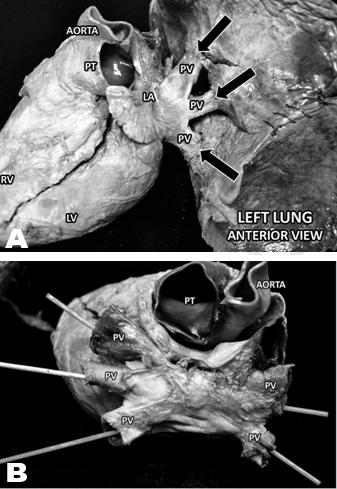 Superiorly, two pulmonary veins can be observed that connected the right lung to the left atrium.