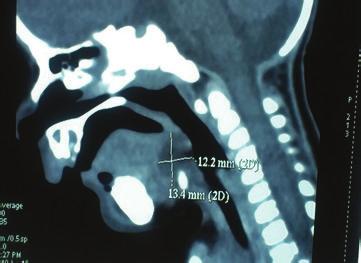 2 Case Reports in Otolaryngology Figure 1: Contrast enhanced computed tomographic scan showing nonenhancing fluid filled lesion located at base of tongue of 12.2 13.4 mm.
