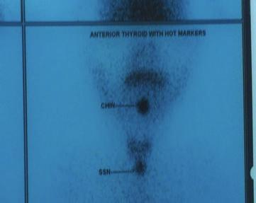 No abnormal tracer uptake was seen in the clinically palpable swelling at the base of the tongue. guidance (Figure 3).