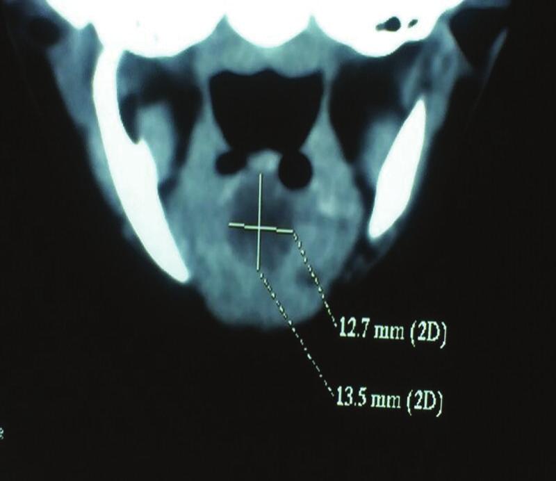 Flexible fiberoptic bronchoscopy was done which revealed a large swelling at the base of tongue obscuring the view of laryngeal inlet.