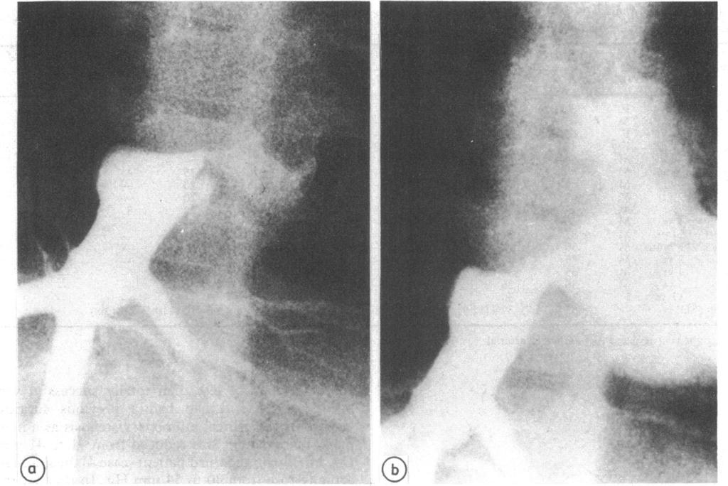 288 Miller 0 0D Fig. 3 Case 17: angiograms showing severe stenosis at the lower limb of an atrial baffle (Mustard's operation) before (a) and after (b) balloon angioplasty.