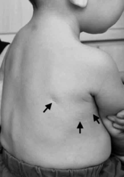 # Thoracoscopic operations in children # chest wall could distort the thoracic cage as the child grows.
