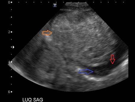 This mass lacked flow on Doppler (Figure 4). Ultrasound also was notable for moderate complex ascites with debris consistent with blood products (Figure 2).