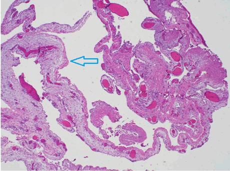 Figure 8: Collapsed cystic lining within the fibrovascular septa, rare lymphocyte filled channels are noted (black arrow) (H&E stain, x200).