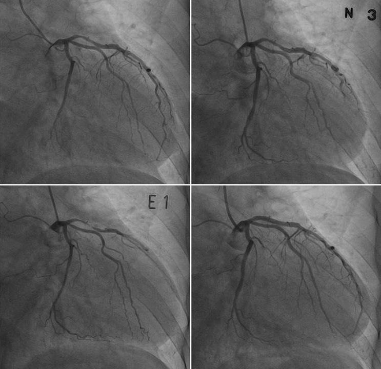 Soo Jin Kim, et al. 103 A B C D Fig. 1. Initial coronary angiography reveals 70% narrowing of proximal LAD (A) and the stenosis is persistent after intracoronary nitrates administration (B).
