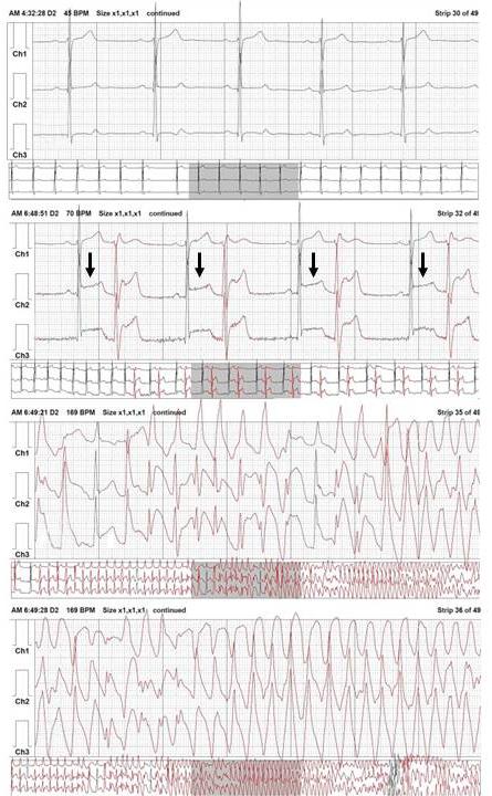 104 Syncope in Patient with Variant Angina A B C D Fig. 2. Channels 1, 2, and 3 of Holter electrocardiogram (ECG) are regarded as lead V1, V6, and II of the 12 lead ECG, respectively.