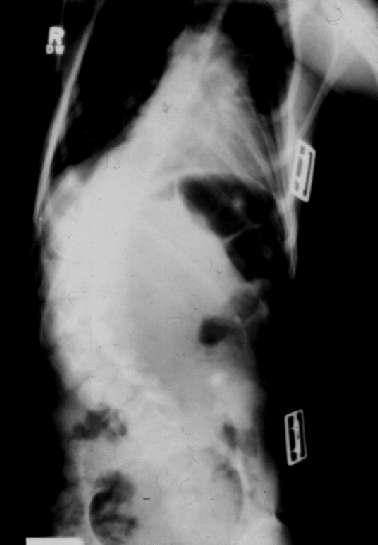 SCOLIOSIS IN CEREBRAL PALSY SURGICAL INDICATIONS: