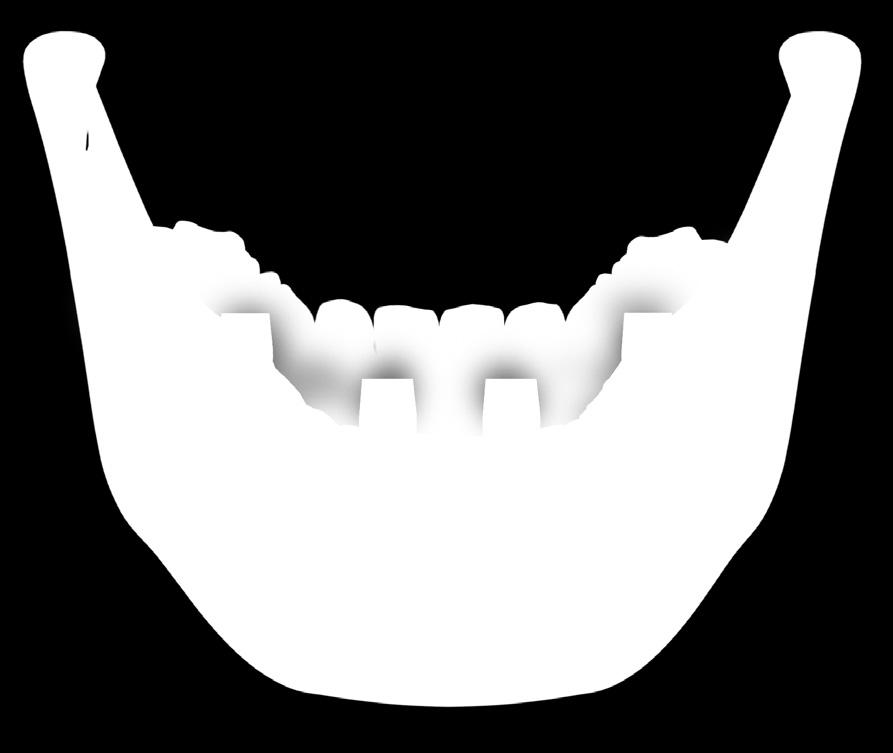 Two Techniques for Connecting Immediate Denture to Patient: Option 1 a. Place healing abutment into multi-unit (Fig. 9) b.