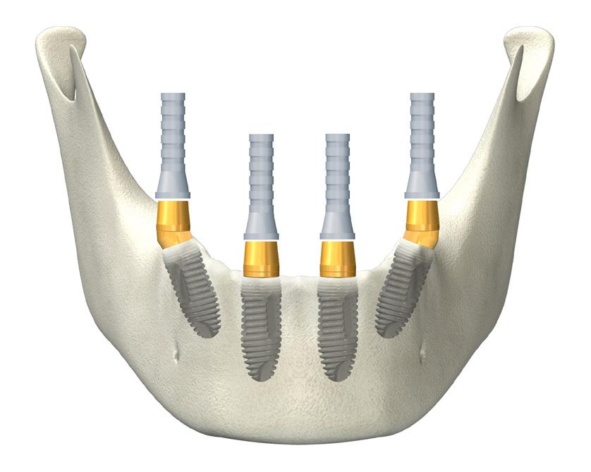 e. Position denture precisely above healing cap and confirm occlusion prior to acrylic hardening. (Fig. 10) f. Remove rubber dam. Fig.