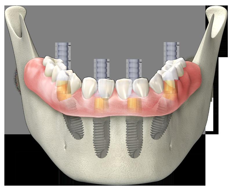 Place rubber dam above the gingival tissue. c. Make hole in the denture so all titanium sleeves can go through denture. d. Place cold cure acrylic in denture implant opening and insert denture to multi-unit titanium sleeve.