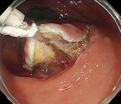 6, " Video 1) to provide good visibility of the submucosal layer.