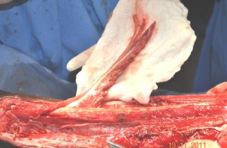 Peroneus brevis muscle flap to cover tendo achilles Raw area covered with meshed skin graft DISCUSSION: However, muscle flaps remain often the first choice, when dealing with bone infections