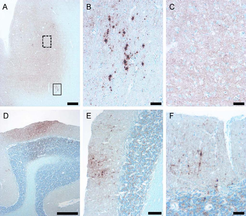 Eigenbrod et al J Neuropathol Exp Neurol Volume 70, Number 3, March 2011 FIGURE 5. Immunohistochemistry for pathological PrP deposition in Case 4. (AYC) PrP deposits in the frontal cortex.