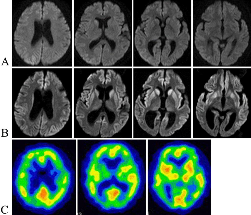 Figure 1. Radiological findings of V210I CJD. (A): Diffusion-weighted MRI demonstrated a faint high signal intensity in the right caudate and occipital lobes on the patient s initial visit.