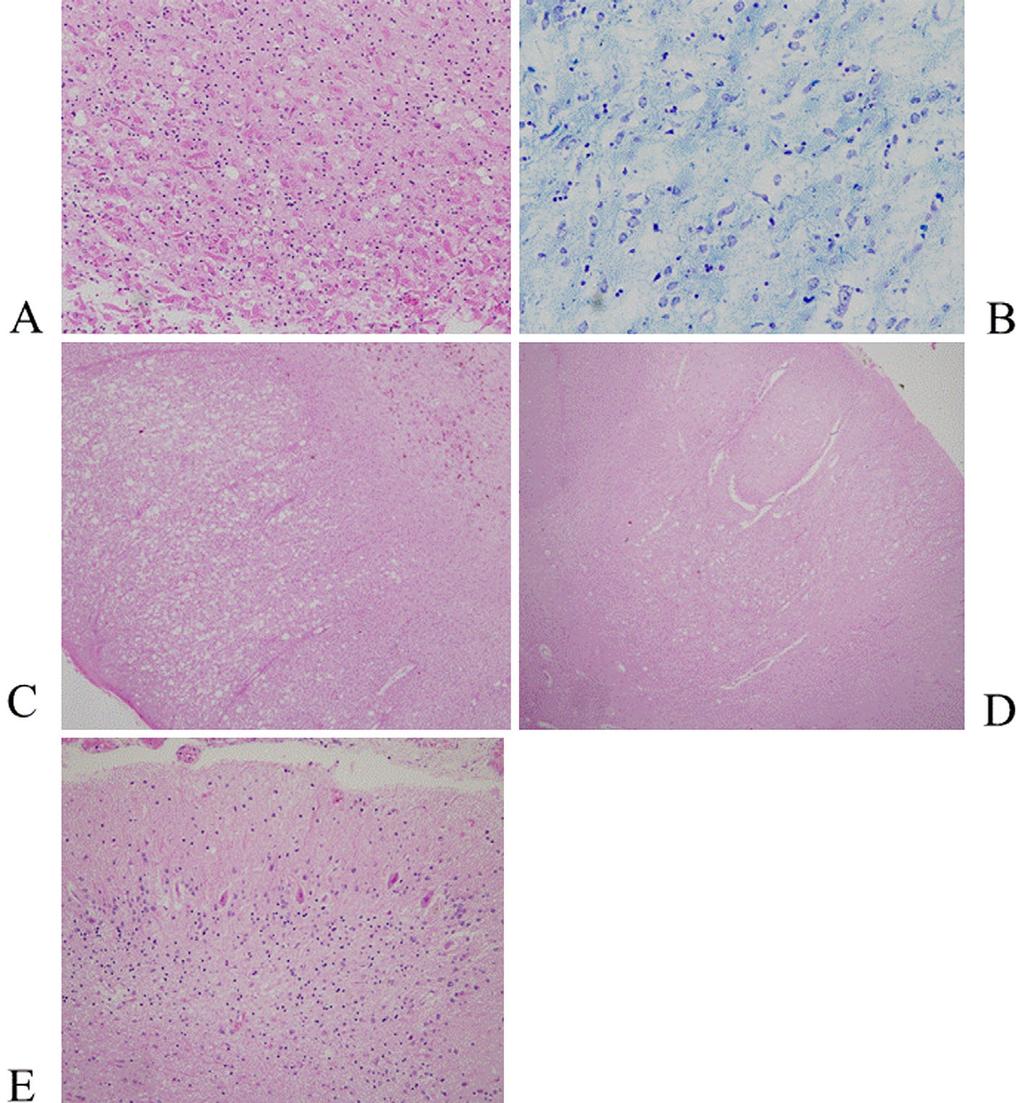 Figure 4. Histological examinations of V210I CJD. Spongiform degeneration and reactive astrocytosis were observed in the caudate nucleus (A).